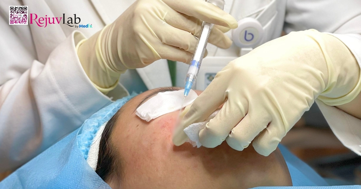 Minh hoa tiem filler Tiem radiesse co chua CaHA