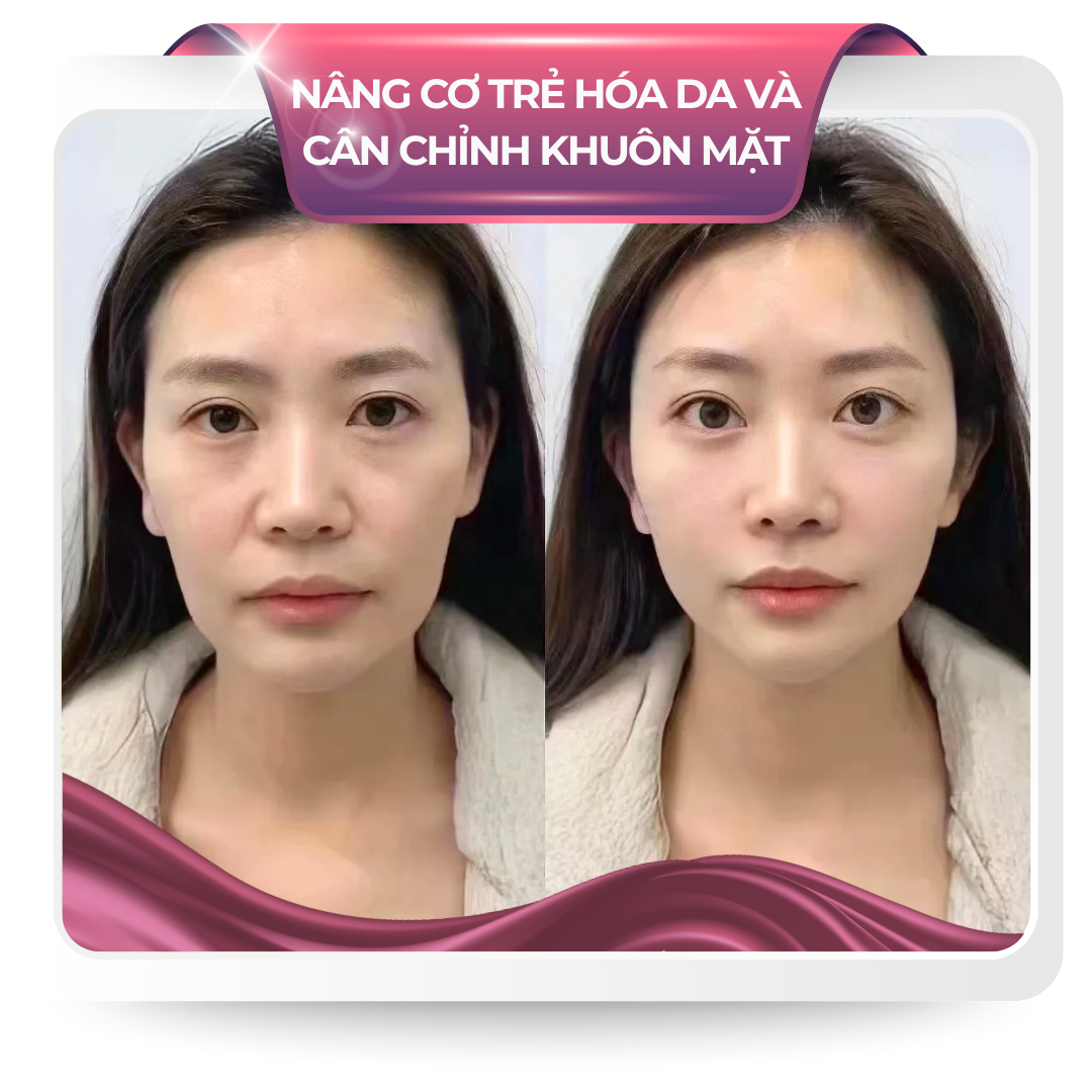 Nâng cơ trẻ hóa da và cân chỉnh khuôn mặt