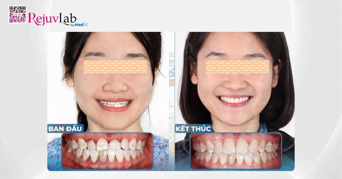 Giải đáp: Niềng răng có giúp mặt thon gọn không? 6 Nieng rang mom