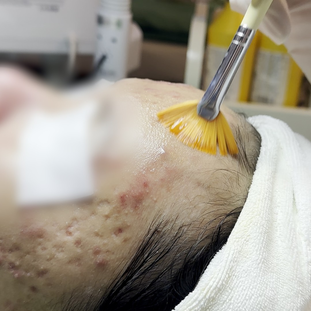 Peel da điều trị sẹo rỗ và sẹo sau mụn