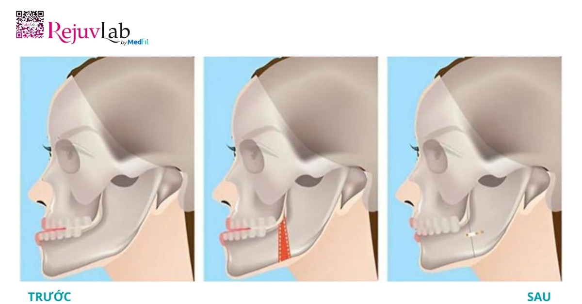 4 phương pháp thẩm mỹ làm gương mặt thon gọn, cân đối 6 Phau thuat got ham