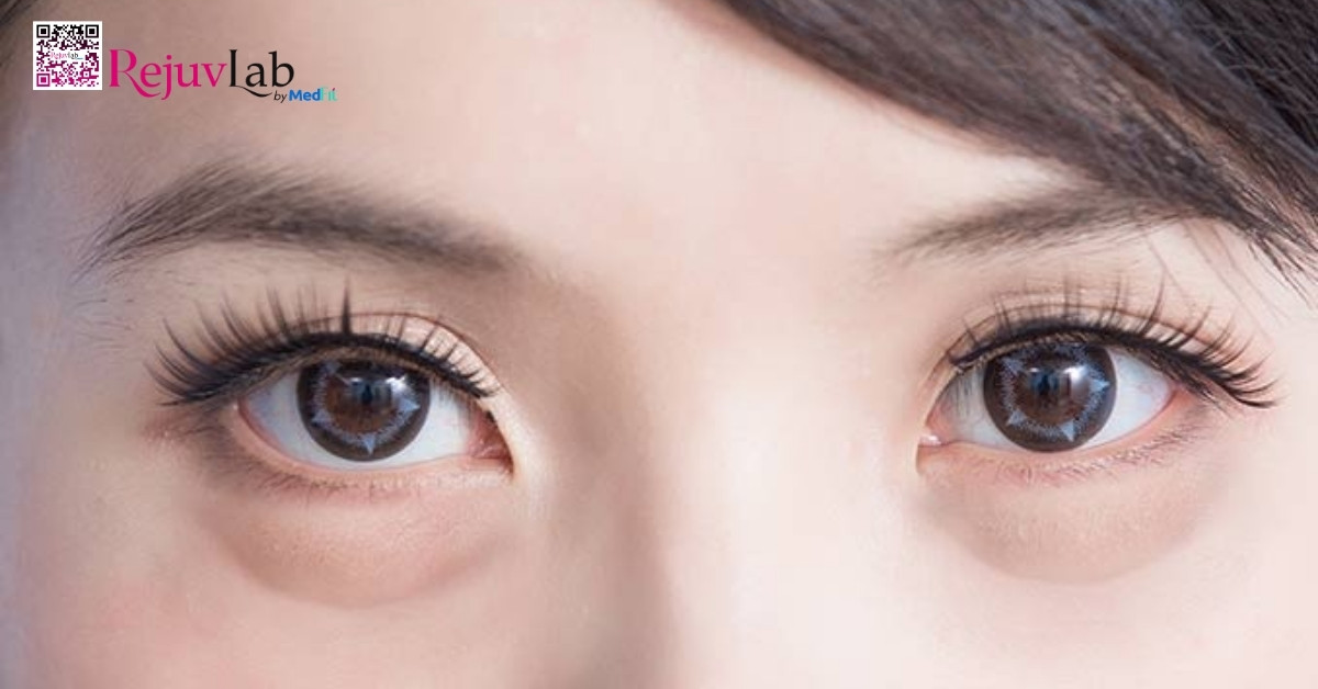 Người có bọng do thoát vị túi mỡ mí dưới có thể tiêm tan mỡ bọng mắt