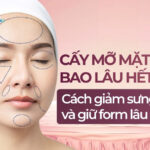 Cấy mỡ mặt bao lâu hết sưng? Cách giảm sưng nhanh và giữ form lâu dài