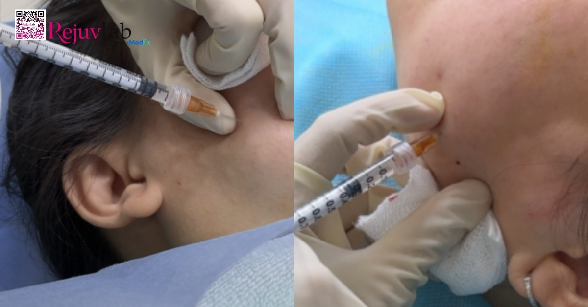 4 phương pháp thẩm mỹ làm gương mặt thon gọn, cân đối 2 Hình minh họa tiêm Botox thon gọn hàm