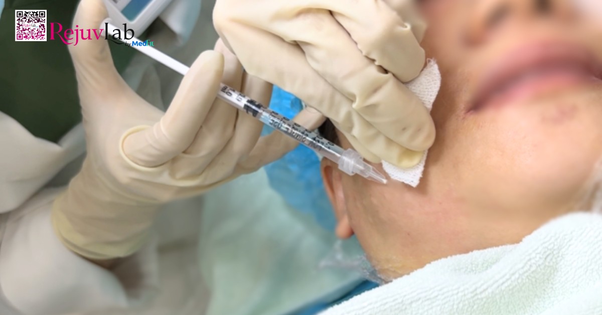 Top phương pháp tiêm thon gọn mặt, giúp sở hữu gương mặt V-line 3 Tiem tan mo mat 1