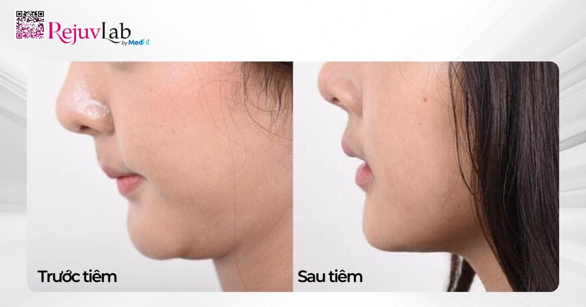 Top phương pháp tiêm thon gọn mặt, giúp sở hữu gương mặt V-line 6 Tiem tan mo mat