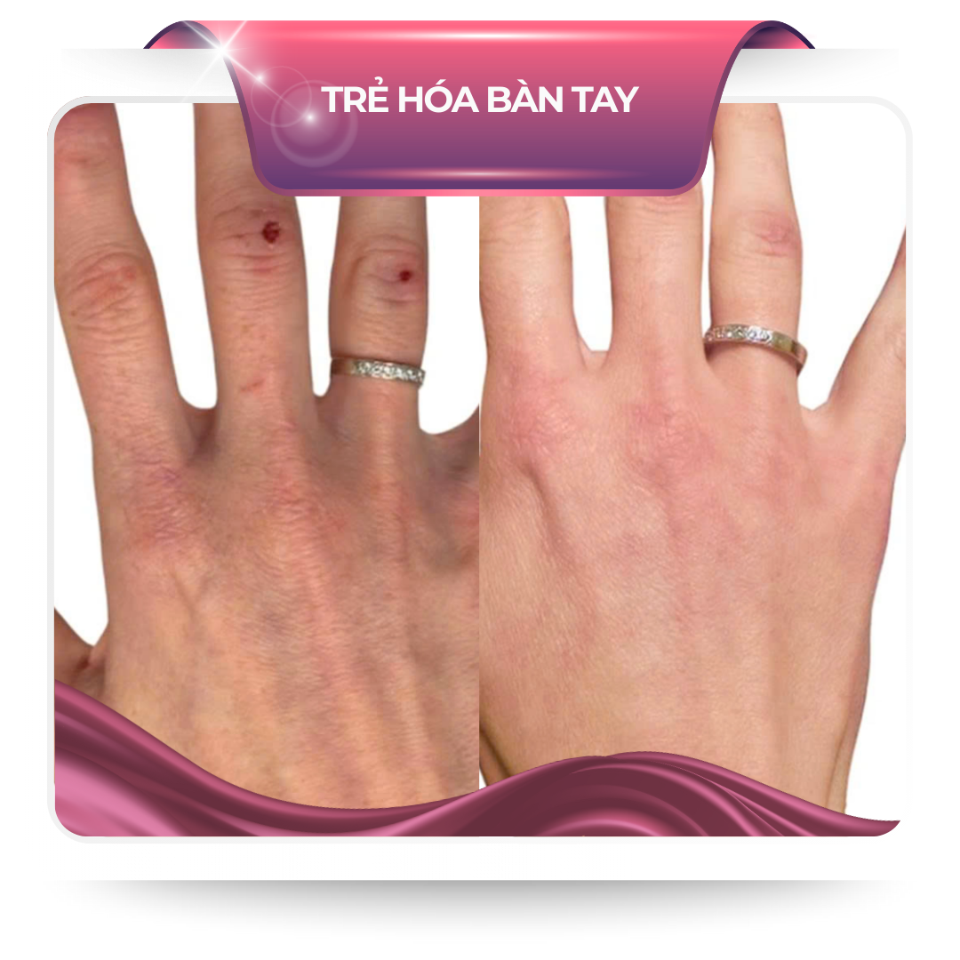 Trẻ hóa bàn tay