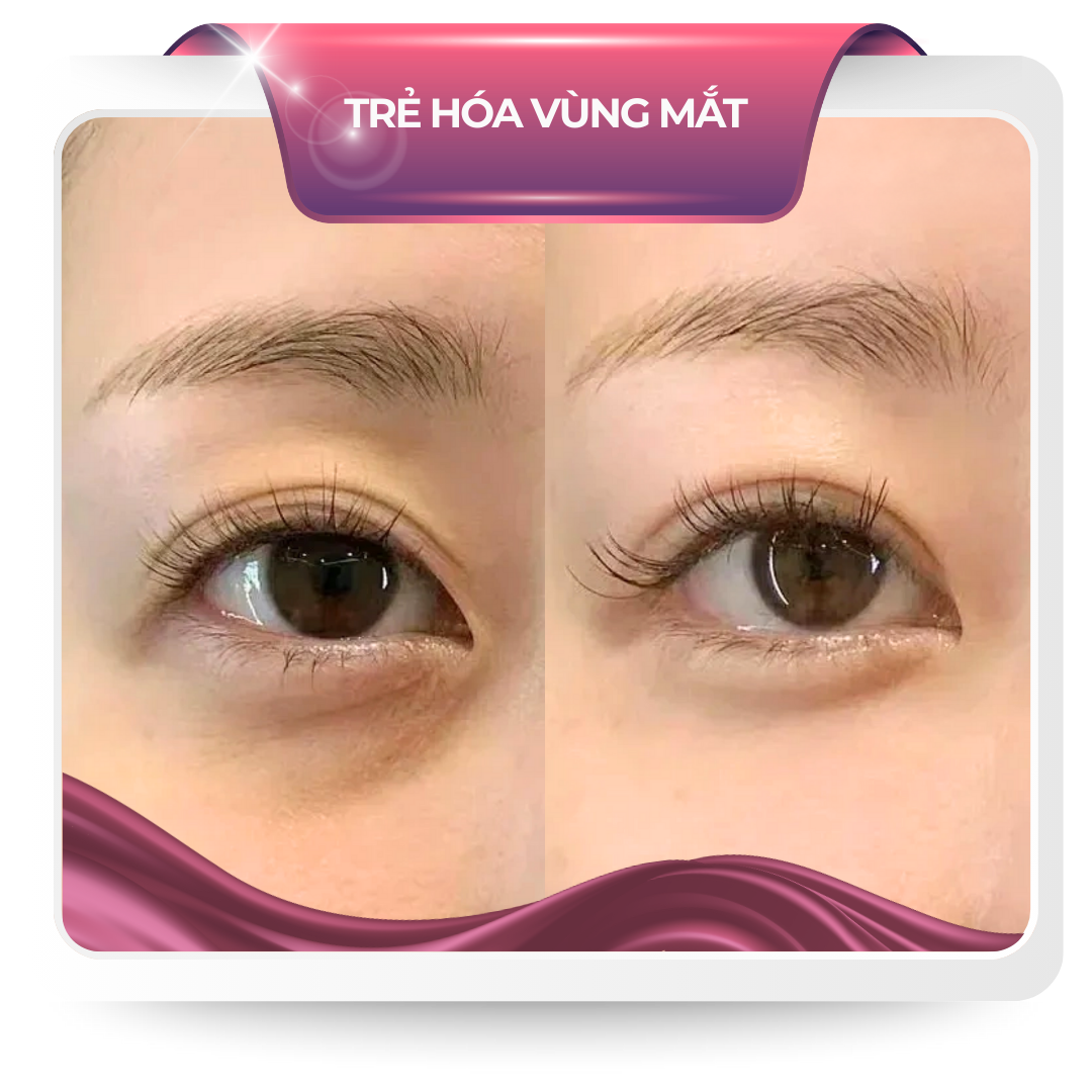 Trẻ hóa vùng mắt