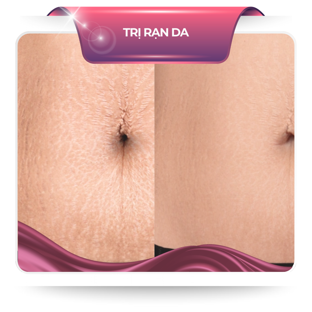 Trị rạn da