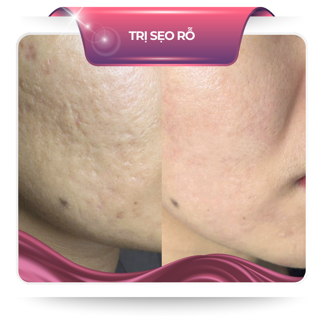 Trị sẹo rỗ