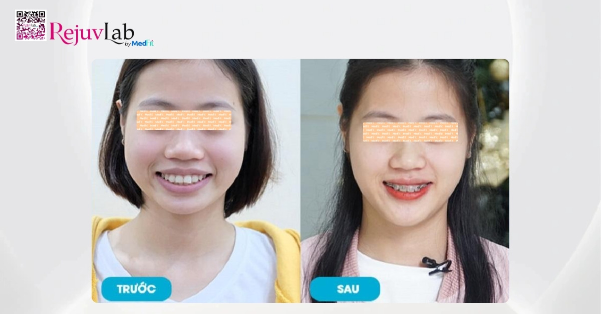 Giải đáp: Niềng răng có giúp mặt thon gọn không? 4 Truoc va sau khi nieng rang