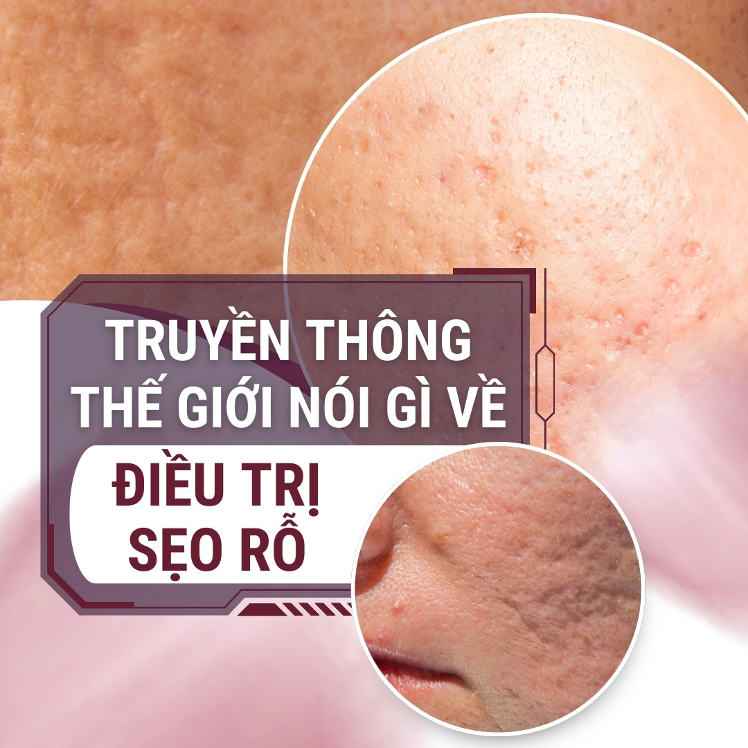 Truyền thông nói gì về Điều trị sẹo rỗ