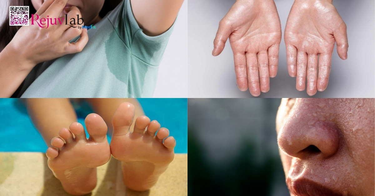 Tiêm Botox trị hôi nách giá bao nhiêu, hiệu quả kéo dài bao lâu? 2 Botox điều trị tăng tiết mồ hôi nách, lòng bàn tay, bàn chân hoặc mặt