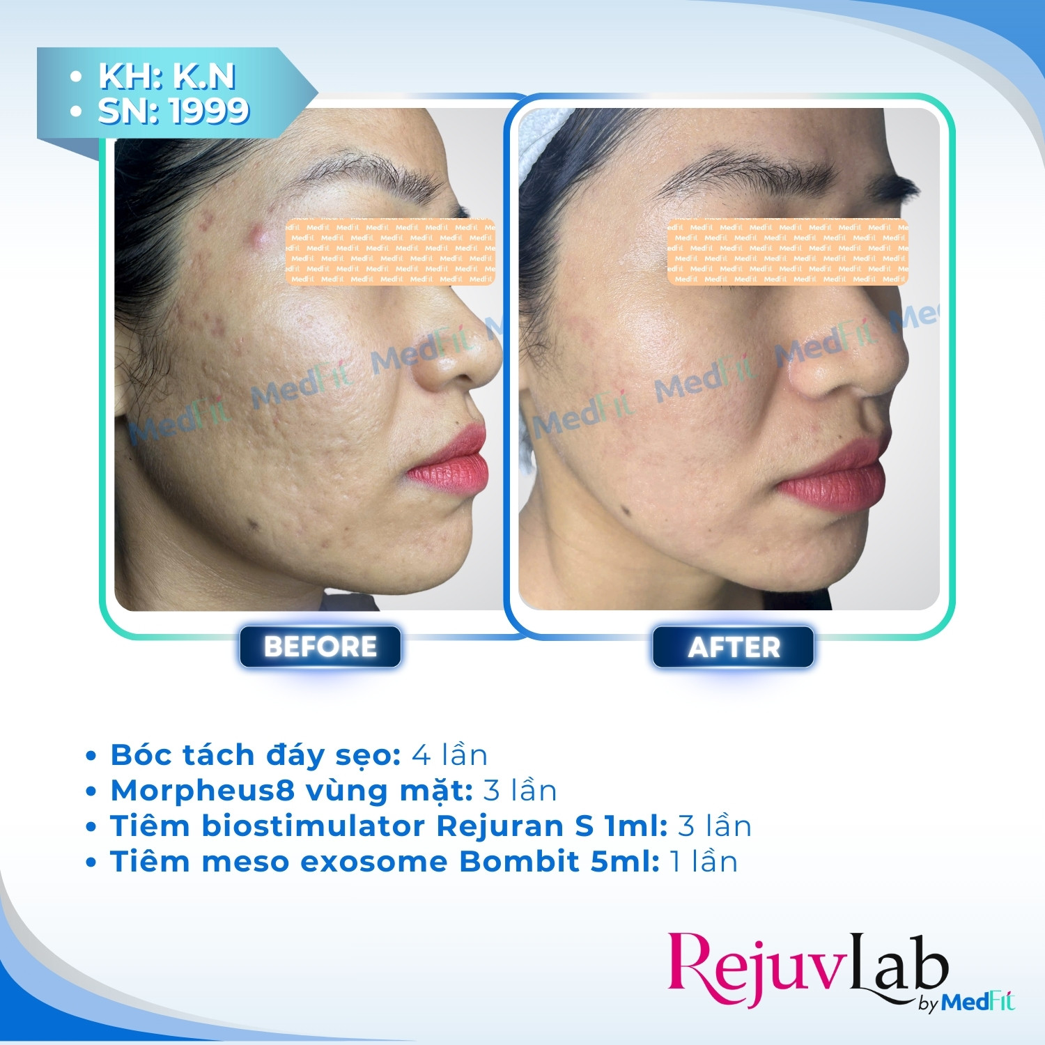 Trị sẹo rỗ 1