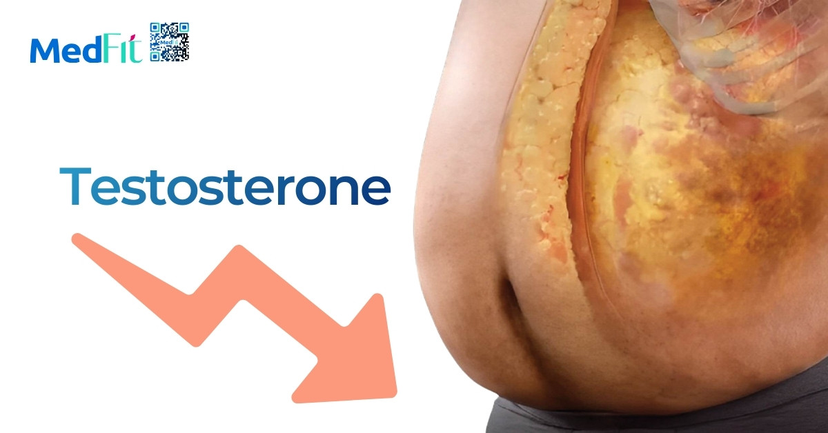 Testosterone thấp và béo phì: Làm sao để đảo ngược vòng xoắn bệnh lý? 6 7