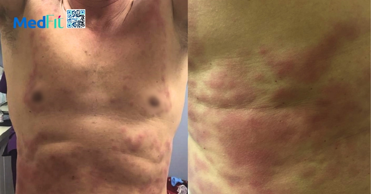 Liệu pháp áp lạnh cryotherapy có thực sự giúp giảm mỡ hay chỉ là quảng cáo? 11 Bong lanh ton thuong da