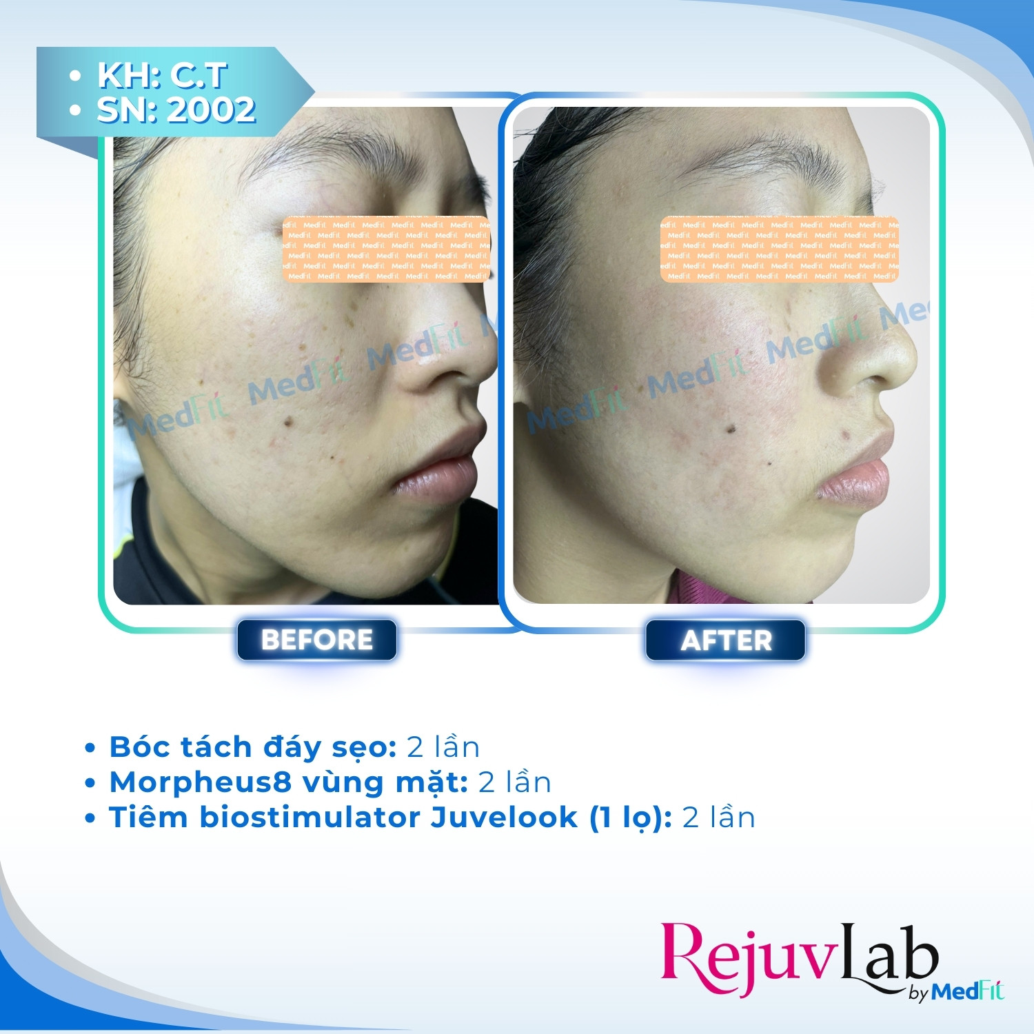 Trị sẹo rỗ 3