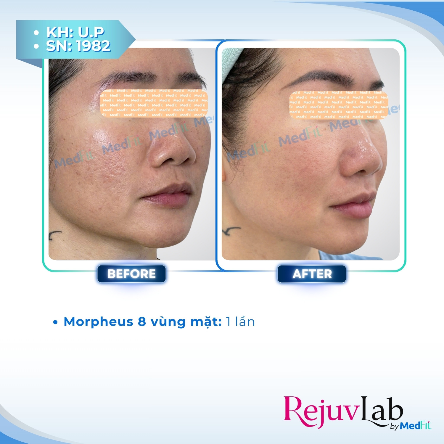 RF vi kim cách điện và không cách điện: Khác nhau thế nào, nên chọn loại nào? 15 RF vi kim cách điện và không cách điện: Khác nhau thế nào, nên chọn loại nào? 14