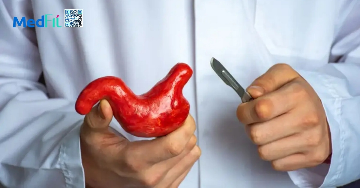 Cắt dạ dày giảm cân là gì? Hiệu quả và rủi ro cần biết trước khi thực hiện 5 Cat da day giam can