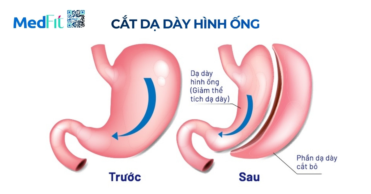 Cắt dạ dày giảm cân là gì? Hiệu quả và rủi ro cần biết trước khi thực hiện 1 Da day ong dung