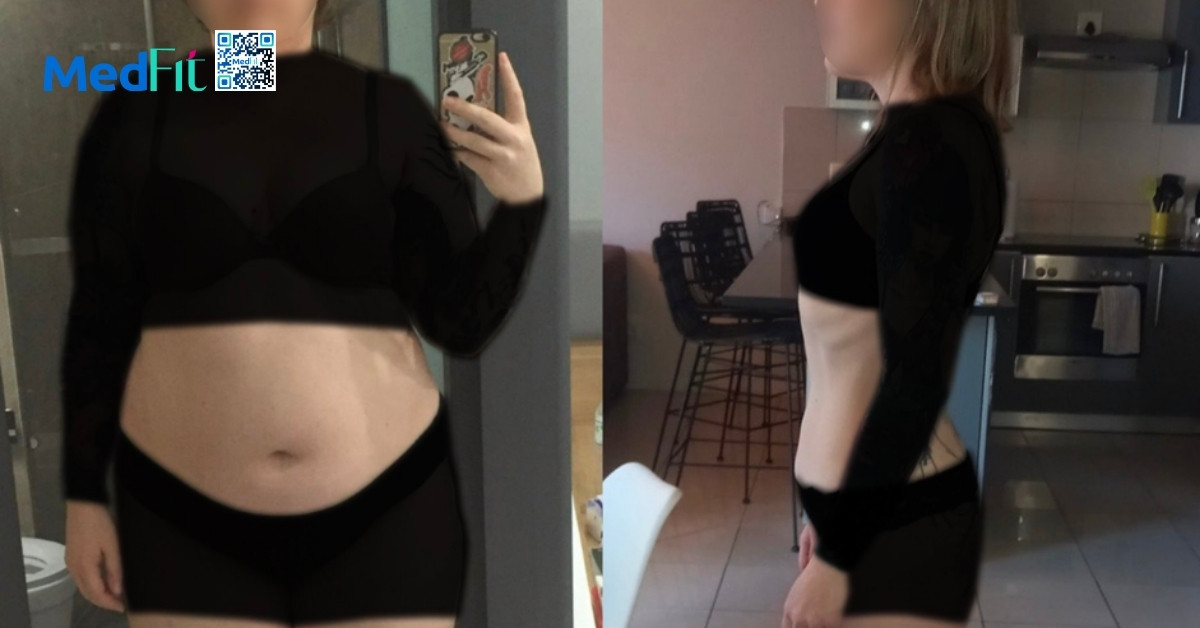 Cắt dạ dày giảm cân là gì? Hiệu quả và rủi ro cần biết trước khi thực hiện 7 Hieu qua 1