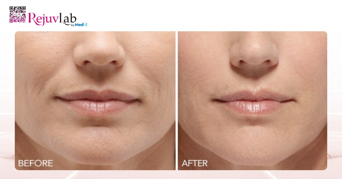 Filler Juvederm giá bao nhiêu 1cc? Bảng giá chi tiết cho từng dòng 4 Hieu qua 3