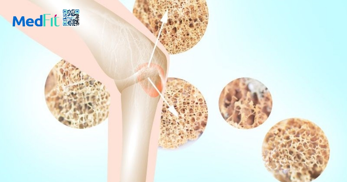 Cách giảm béo an toàn và hiệu quả cho người cao tuổi 1 Khi tuổi tác tăng lên, xương của người già mất dần tính đàn hồi, dẫn đến giảm khả năng chịu tải