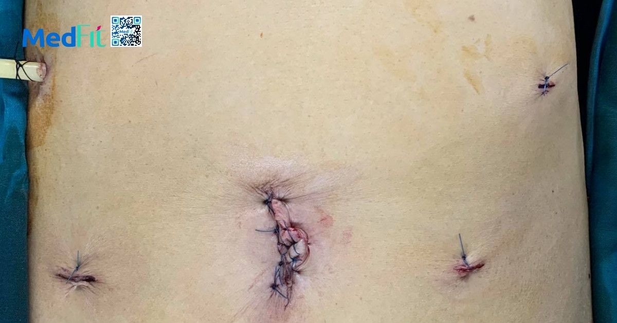 Nhiem trung hoac chay mau sau mo