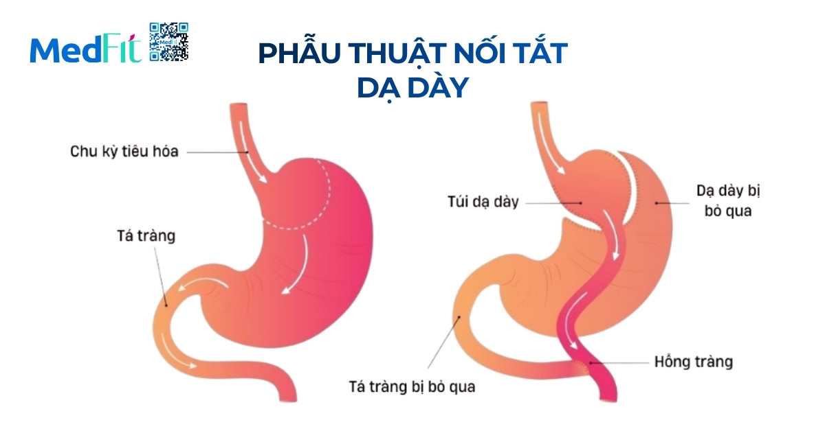 Cắt dạ dày giảm cân là gì? Hiệu quả và rủi ro cần biết trước khi thực hiện 2 Noi tat da day