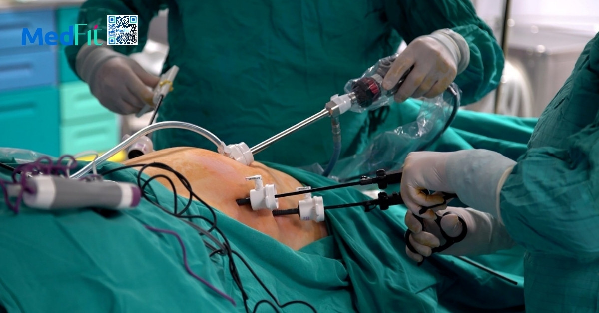 Cắt dạ dày giảm cân là gì? Hiệu quả và rủi ro cần biết trước khi thực hiện 10 Phau thuat cat da day