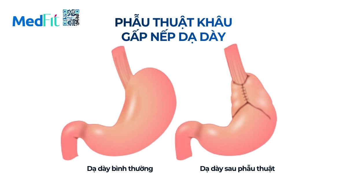 Cắt dạ dày giảm cân là gì? Hiệu quả và rủi ro cần biết trước khi thực hiện 3 Phau thuat khau gap nep da day