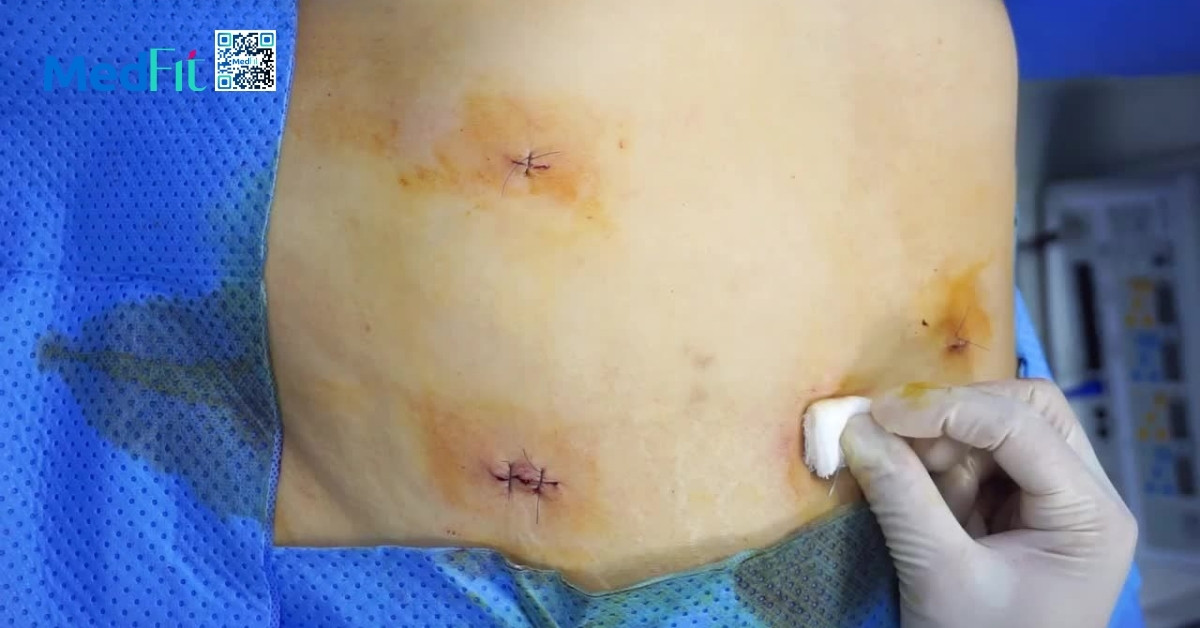 Cắt dạ dày giảm cân là gì? Hiệu quả và rủi ro cần biết trước khi thực hiện 12 Rui ro va bien chung