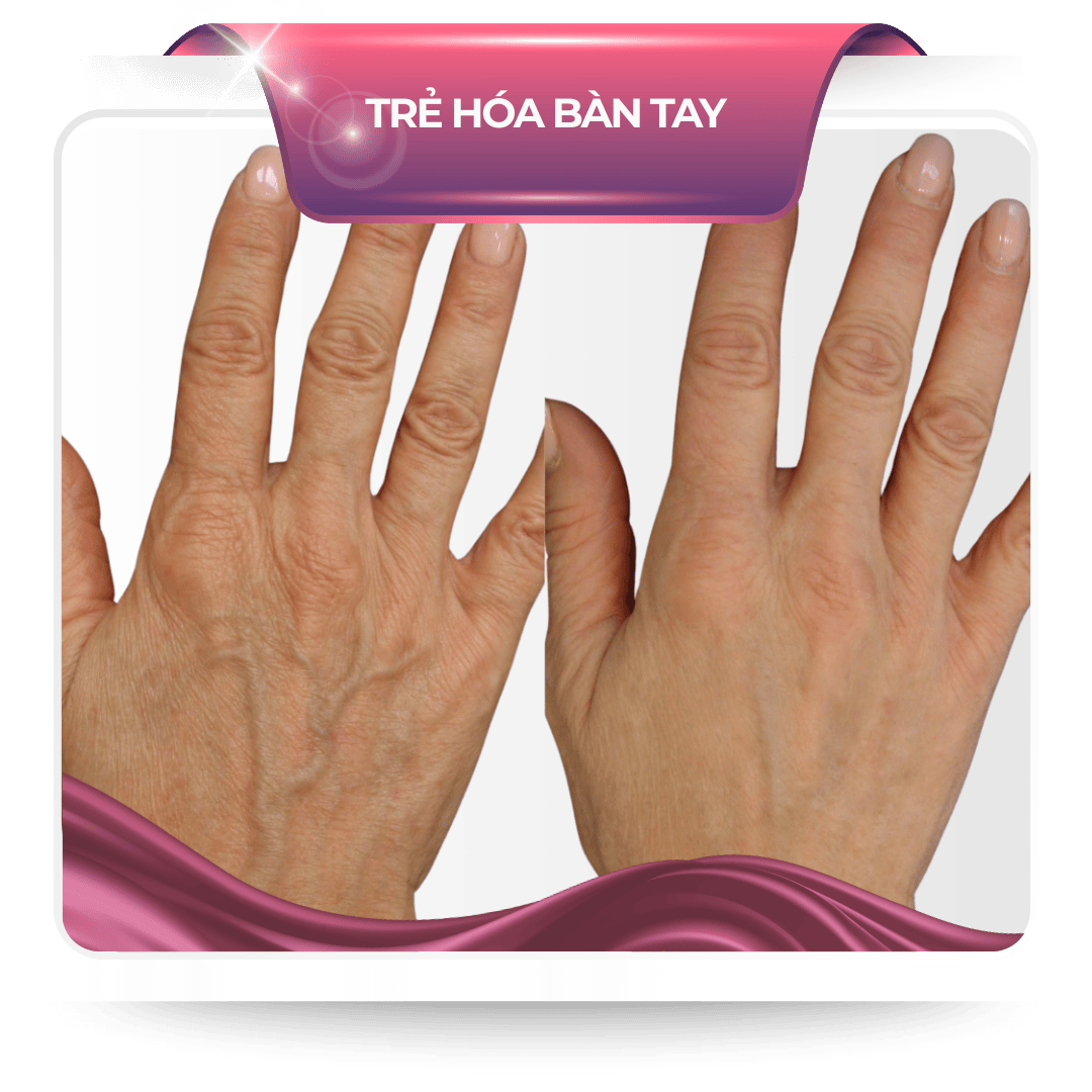 Trẻ hóa bàn tay