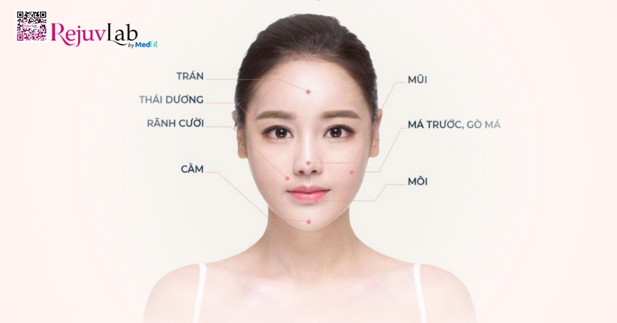 Giá tiêm filler hiện nay bao nhiêu? Bảng giá 2026 và cách chọn filler phù hợp 5 Tung vung tren mat