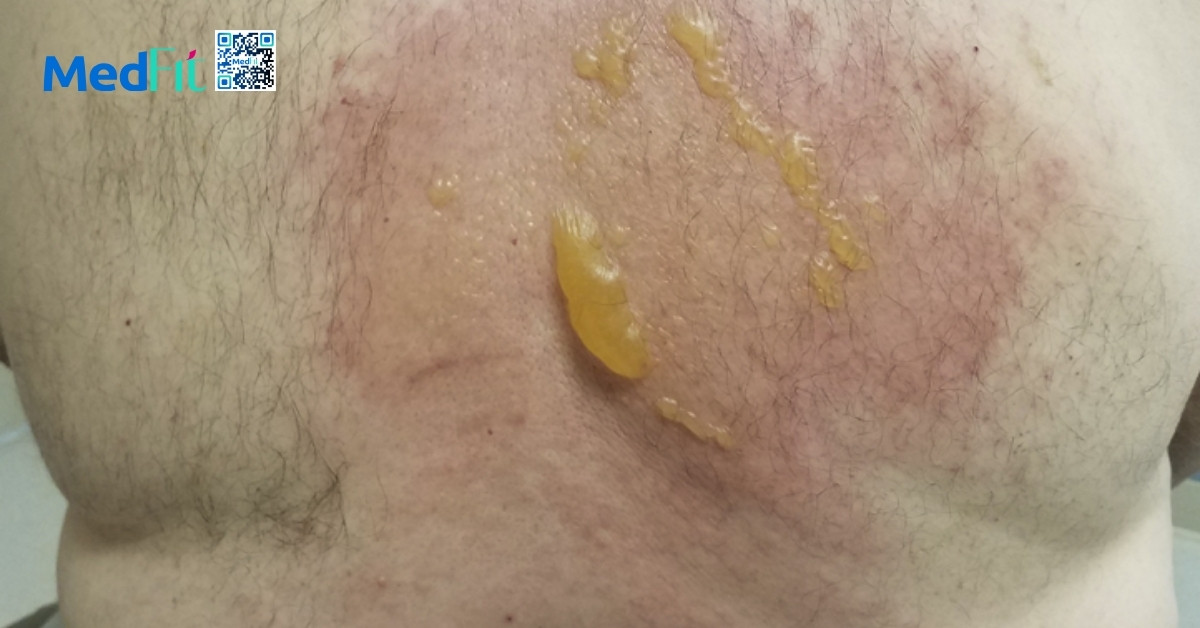 Liệu pháp áp lạnh cryotherapy có thực sự giúp giảm mỡ hay chỉ là quảng cáo? 9 Viem mo mo do lanh