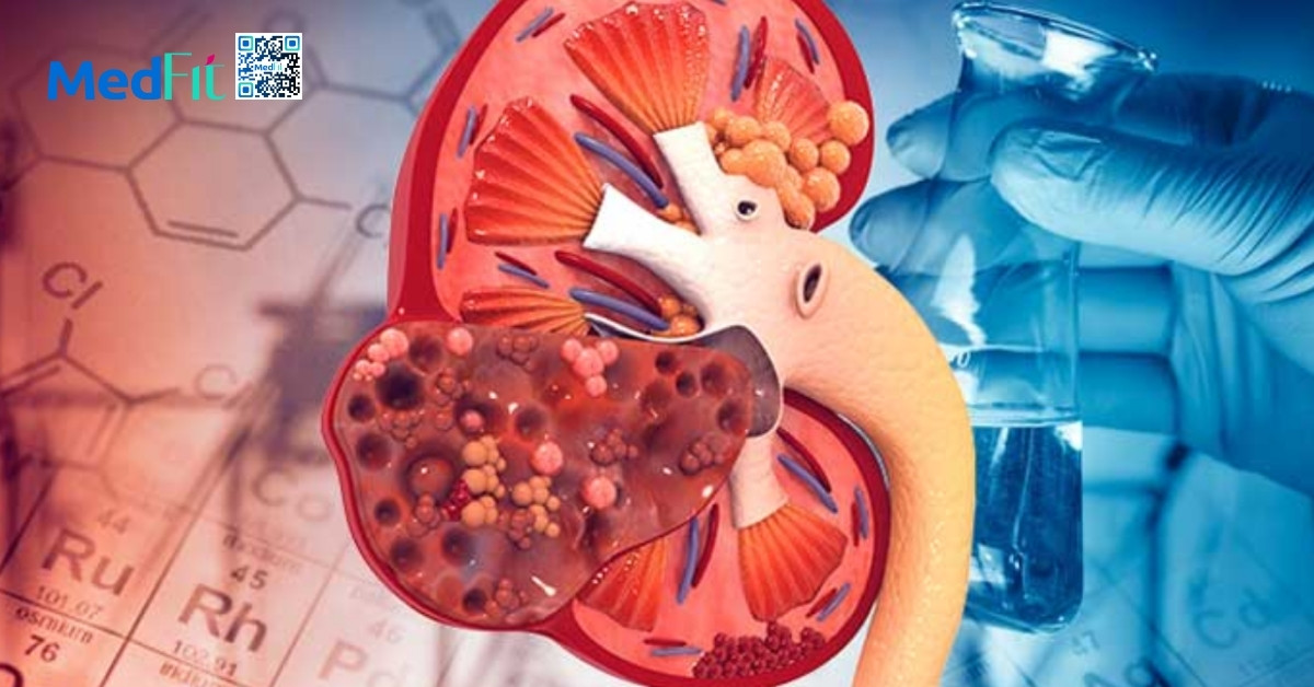 Suy thận và béo phì: Những cảnh báo không thể bỏ qua 1 Benh than man tinh