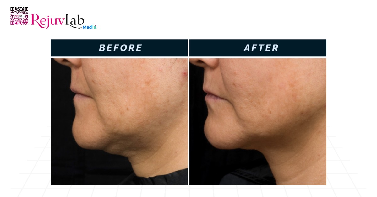 Trẻ hoá da bằng công nghệ Thermage FLX: Nguyên lý, hiệu quả và lưu ý khi lựa chọn 11 Trẻ hoá da bằng công nghệ Thermage FLX: Nguyên lý, hiệu quả và lưu ý khi lựa chọn 10