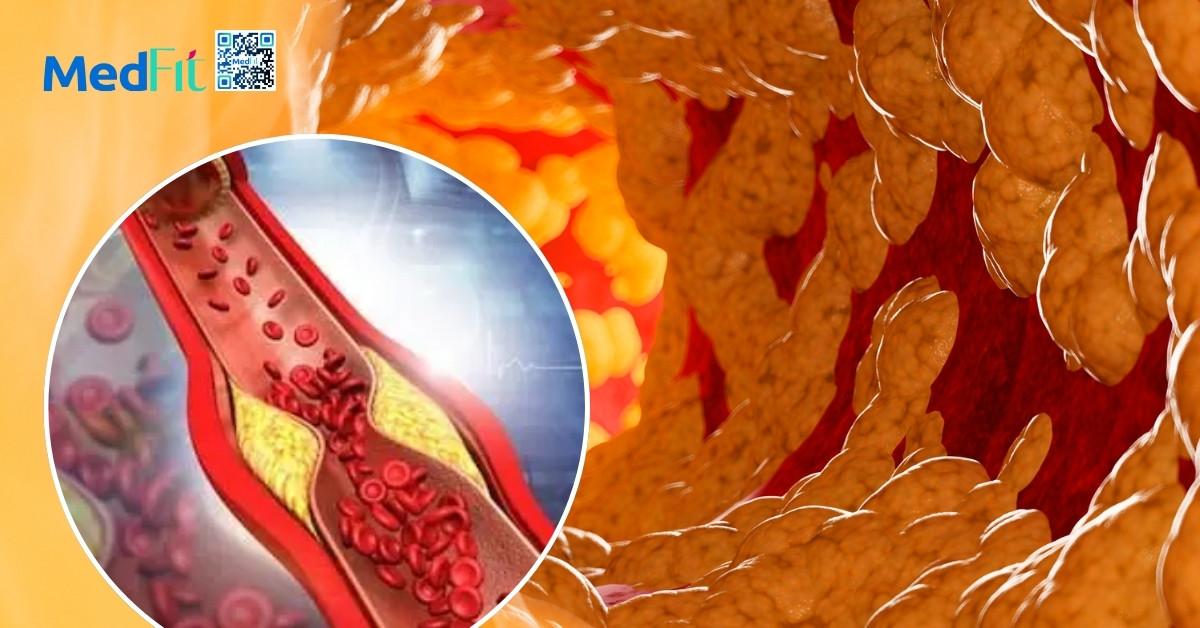 Suy thận và béo phì: Những cảnh báo không thể bỏ qua 6 Mo trong long mach