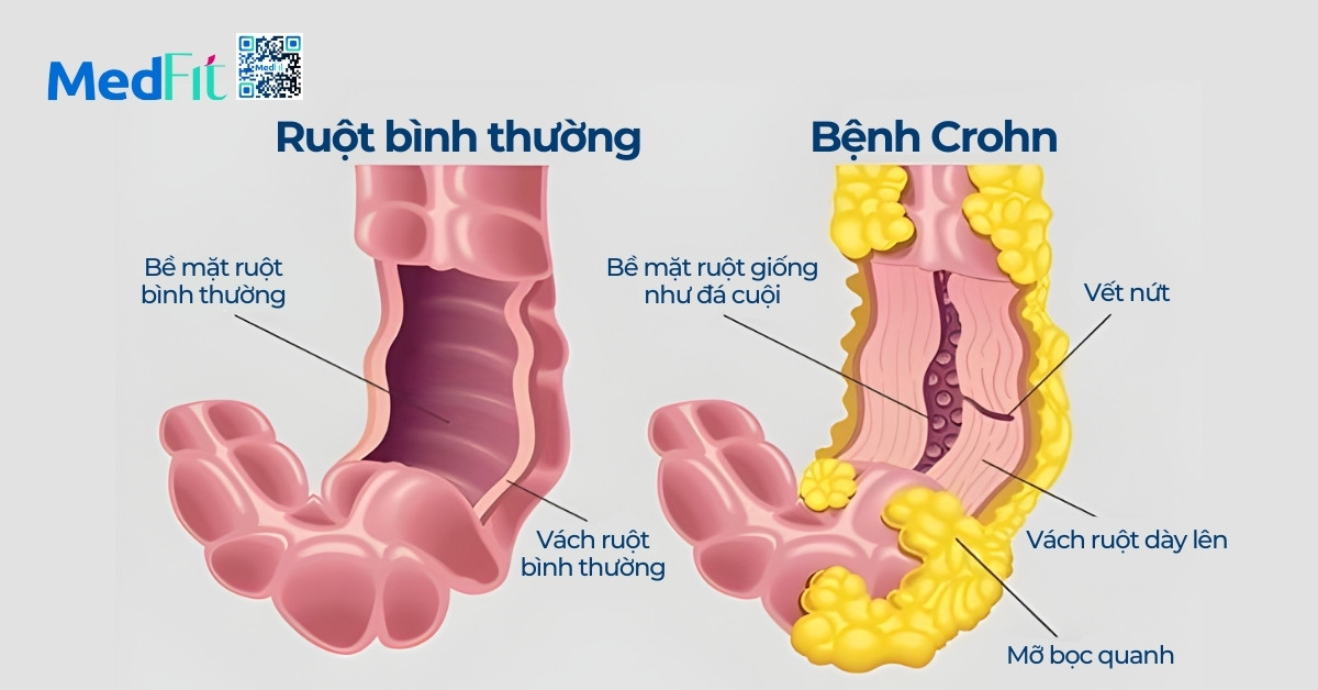 Vì sao mỡ nội tạng cao gây cản trở tiêu hóa? 6 Vì sao mỡ nội tạng cao gây cản trở tiêu hóa? 5