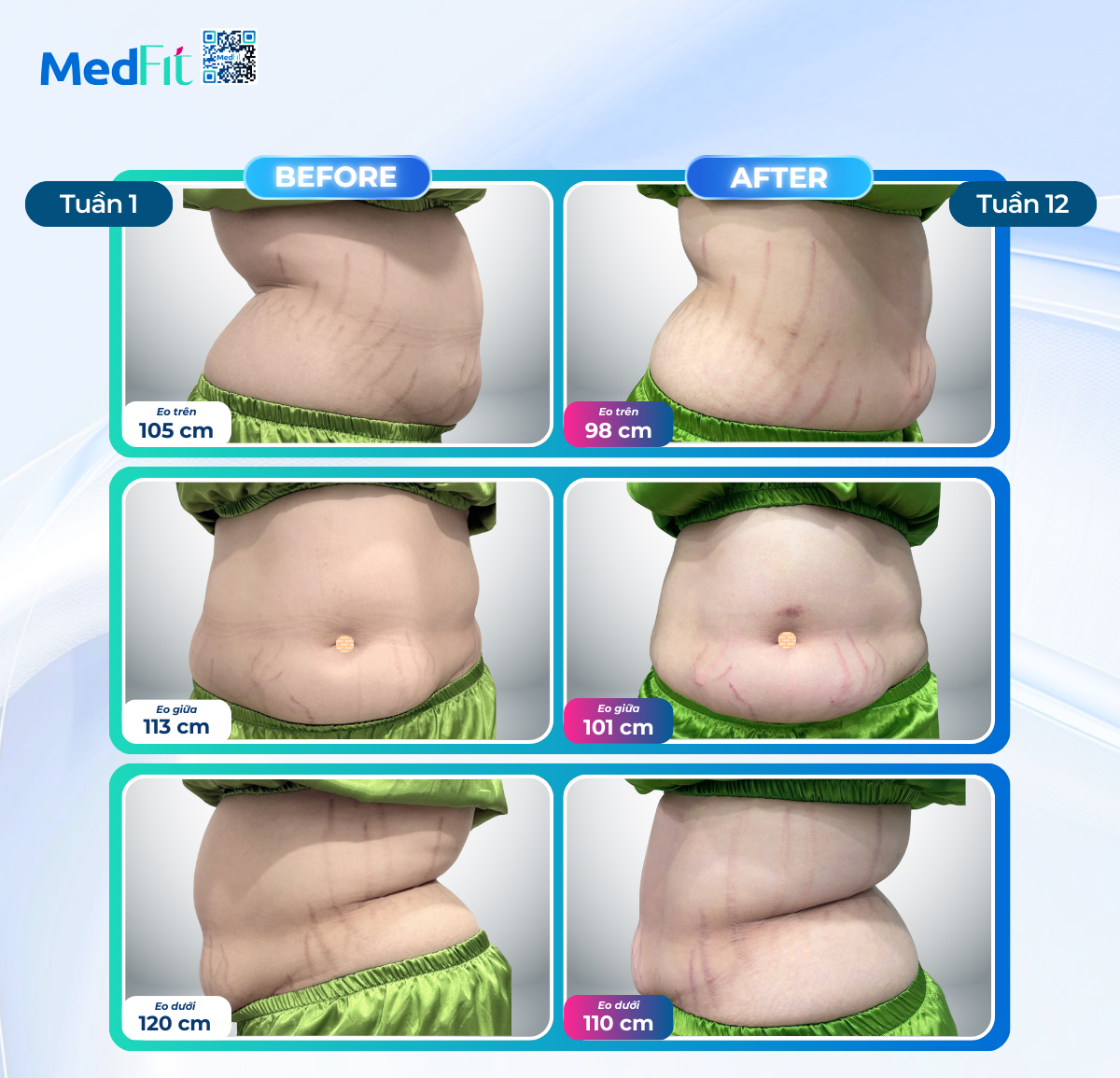 Cô gái 18 tuổi và hành trình yêu thương bản thân cùng MedFit 3 So do vong eo