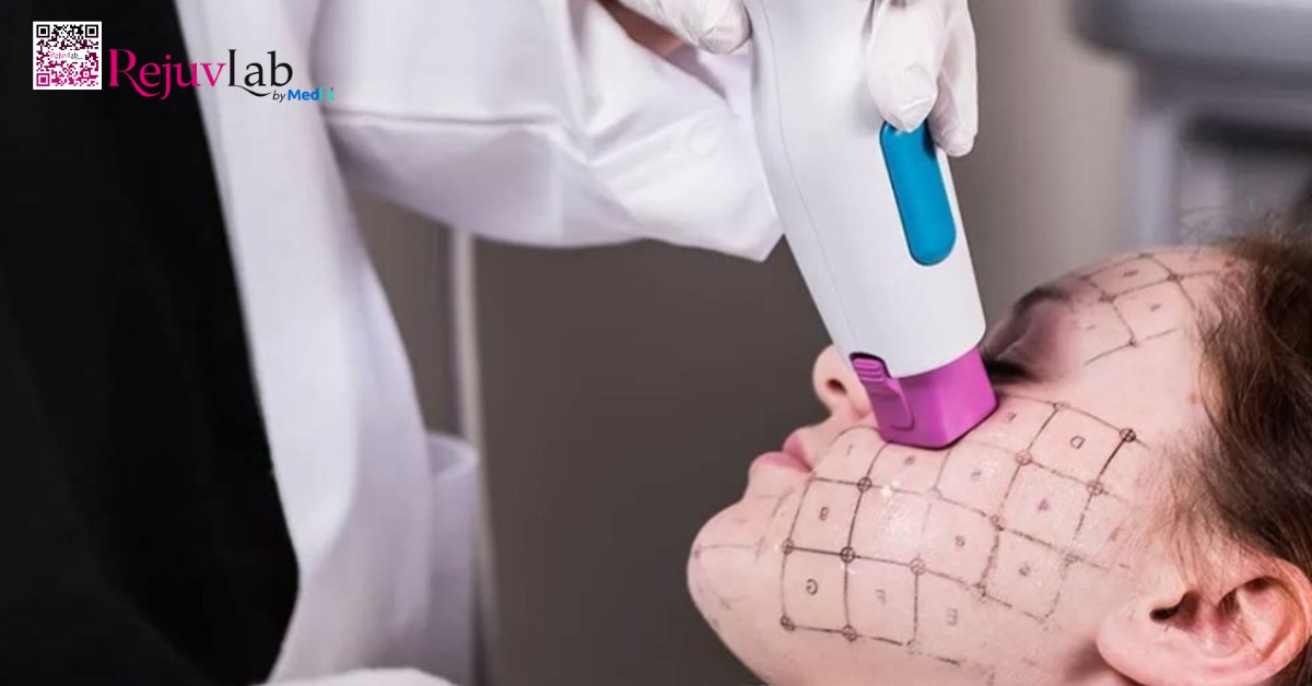 Trẻ hoá da bằng công nghệ Thermage FLX: Nguyên lý, hiệu quả và lưu ý khi lựa chọn 13 Trẻ hoá da bằng công nghệ Thermage FLX: Nguyên lý, hiệu quả và lưu ý khi lựa chọn 12