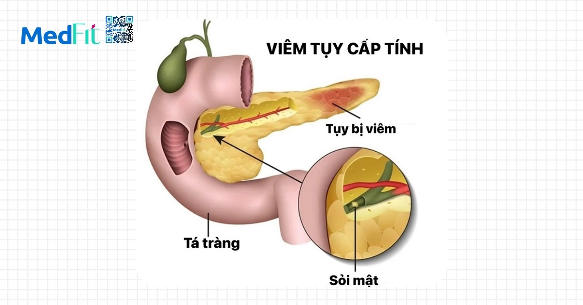 Vì sao mỡ nội tạng cao gây cản trở tiêu hóa? 10 Vì sao mỡ nội tạng cao gây cản trở tiêu hóa? 9
