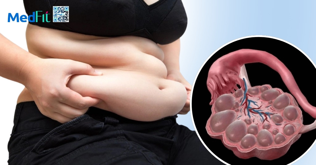 Cách giảm cân cho người mắc đa nang buồng trứng 8 Cách giảm cân cho người mắc đa nang buồng trứng 7