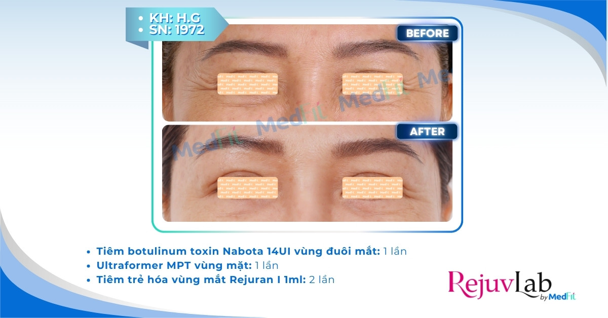 Tiêm botox xóa nhăn mắt: Giải pháp làm mờ vết chân chim thần tốc 5 Tiêm botox xóa nhăn mắt: Giải pháp làm mờ vết chân chim thần tốc 4