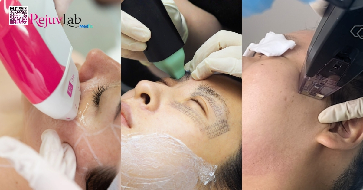 Tiêm botox xóa nhăn mắt: Giải pháp làm mờ vết chân chim thần tốc 11 Tiêm botox xóa nhăn mắt: Giải pháp làm mờ vết chân chim thần tốc 10