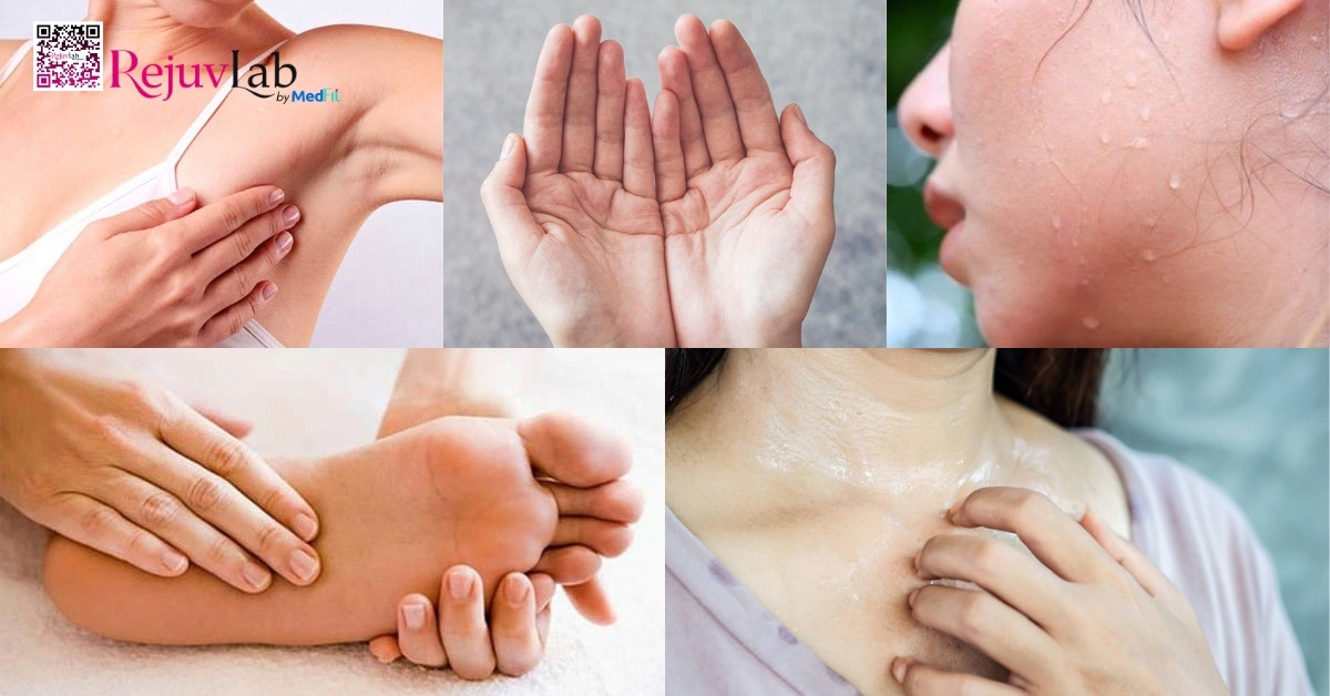 Giá tiêm botox trị mồ hôi tay là bao nhiêu? Bảng giá cập nhật 2026 8 Giá tiêm botox trị mồ hôi tay là bao nhiêu? Bảng giá cập nhật 2026 7