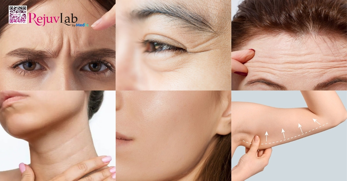 Review các loại botox phổ biến: Loại nào hiệu quả nhất? 17 Review các loại botox phổ biến: Loại nào hiệu quả nhất? 16