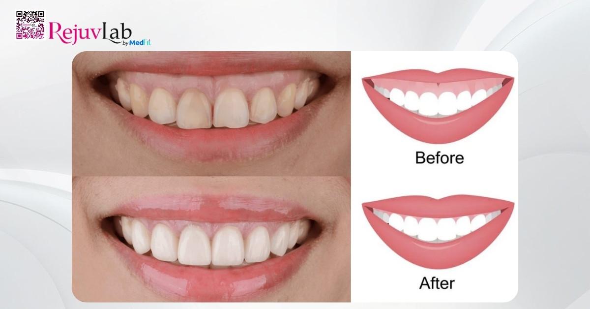 Tiêm botox cười hở lợi có hiệu quả không? Giải đáp từ Bác sĩ Thẩm mỹ 4 Tiêm botox cười hở lợi có hiệu quả không? Giải đáp từ Bác sĩ Thẩm mỹ 3