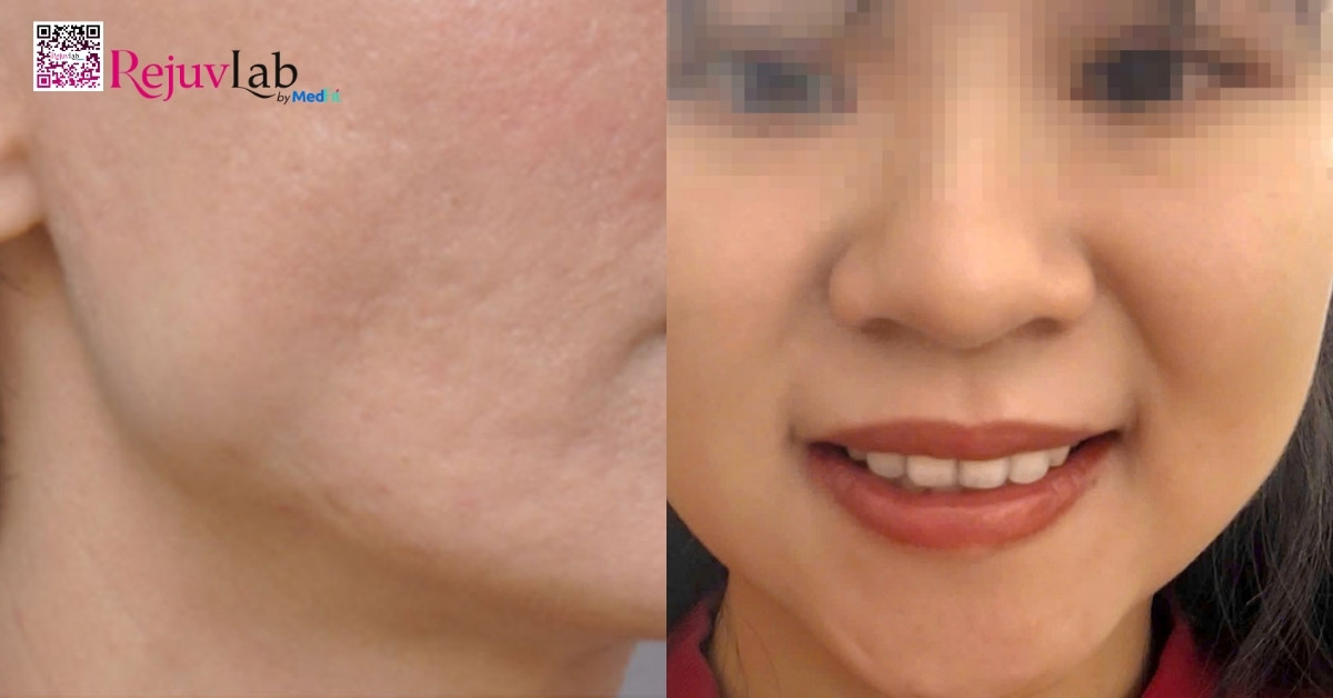 Tiêm botox bị lỗi phải làm sao? Top các cách làm tan botox nhanh và hiệu quả nhất 2 Tiêm botox bị lỗi phải làm sao? Top các cách làm tan botox nhanh và hiệu quả nhất 1