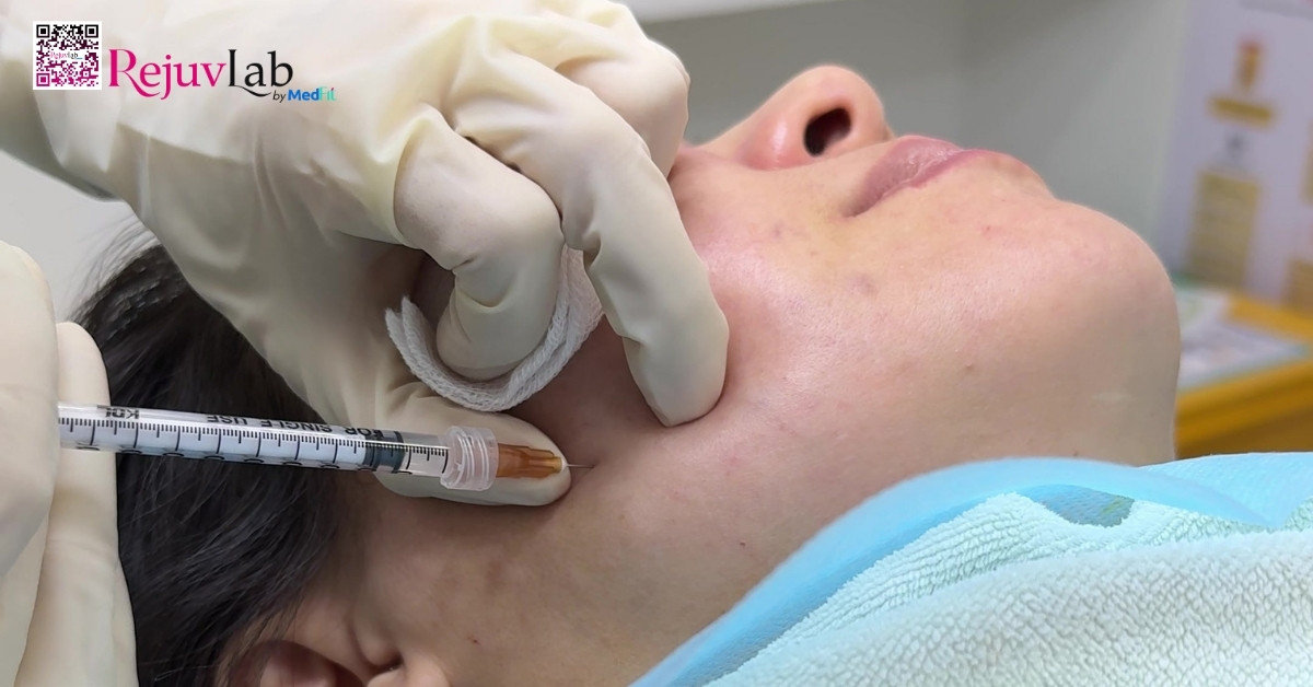 Tiêm botox gọn hàm bao nhiêu cc? Sự thật về cc và unit cần biết trước khi tiêm 2 Tiêm botox gọn hàm bao nhiêu cc? Sự thật về cc và unit cần biết trước khi tiêm 1